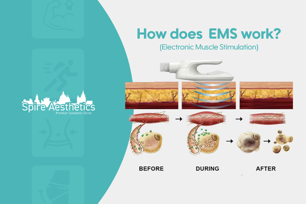 EMS treatment for post pregnancy weight loss treatment Bristol