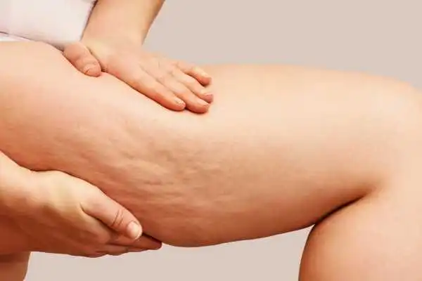 Image of woman showing leg with cellulite Bristol