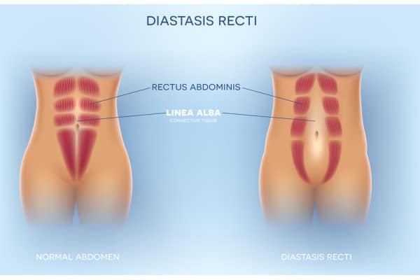 What Non-Surgical Options Are Available for Diastasis Recti Bristol ?