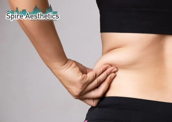 Image of woman pinching fat on their hips Bristol . Fat Freezing treatment