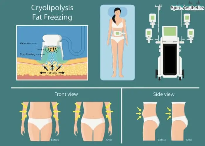 Fat freezing treatment Bristol benefits for competitions to remove stubborn fat deposits.