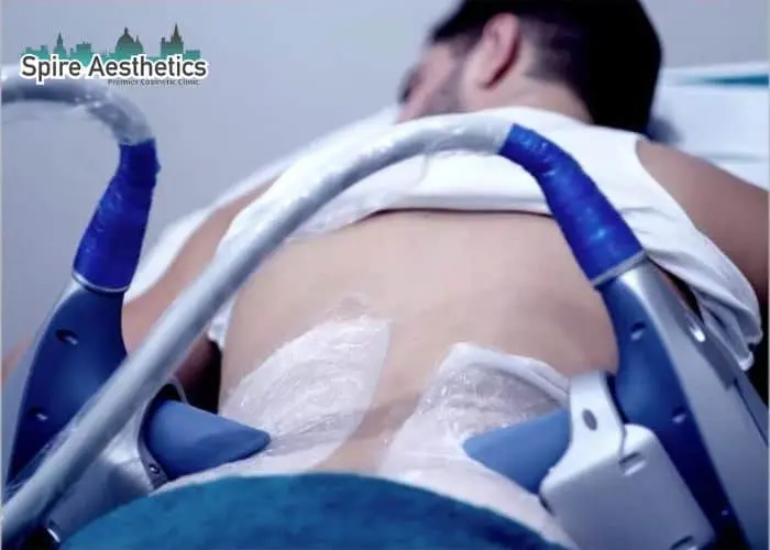 Man having fat freezing treatment done on love handles before a competitions Bristol to create a sculpted look.