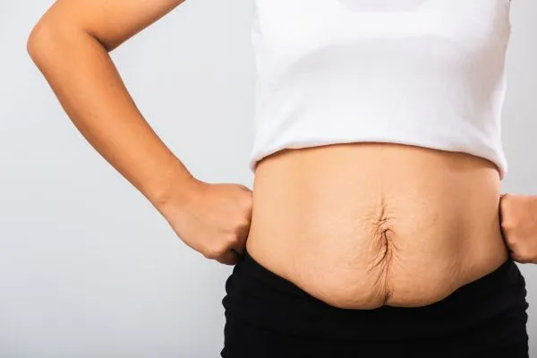 Image of a woman's stomach after weight loss with sagging skin following a gastric band Bristol