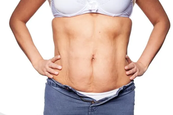 sagging skin on woman's stomach after weight loss injections Bristol