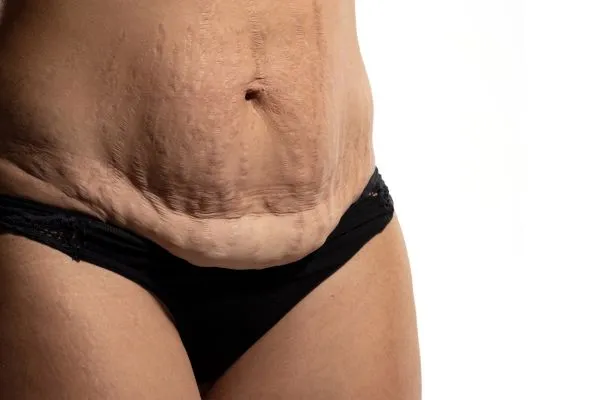 Image of womans stomach after weight loss injections Bristol showing saggy skin