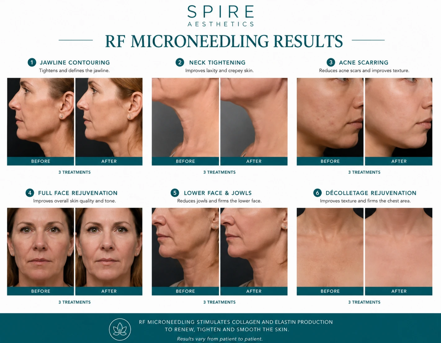 RF Microneedling Skin tightening Bristol results