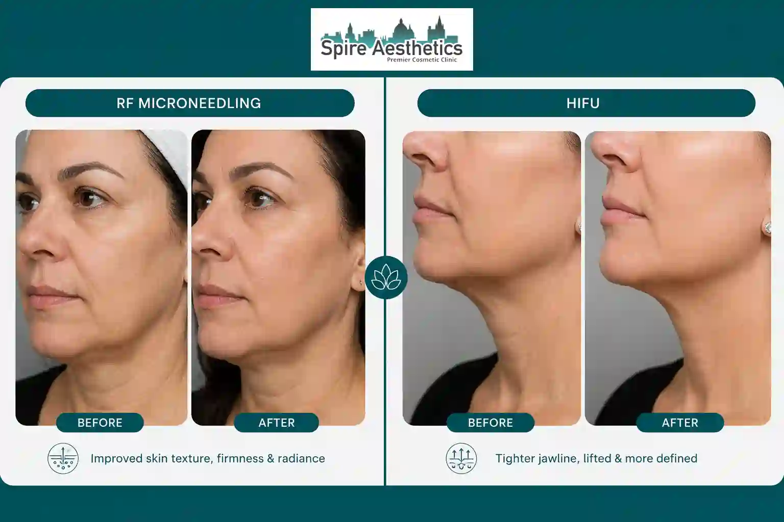 Can RF Microneedling and HIFU Be Combined Bristol ?