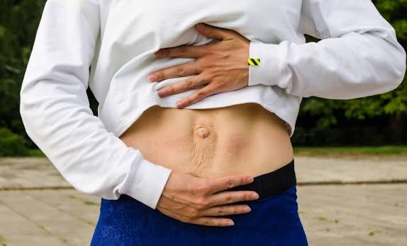 When Could Diastasis Recti Be the Missing Piece of the Puzzle Bristol ?