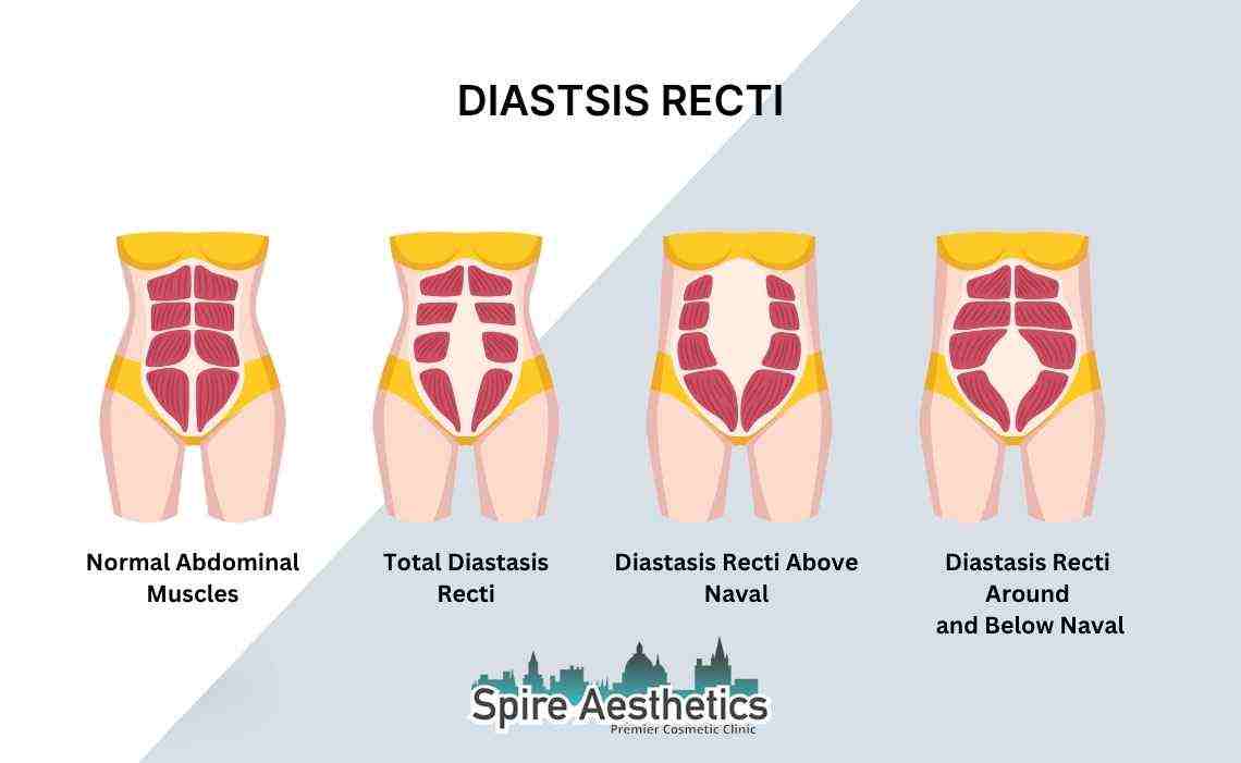 Is Non-Surgical Diastasis Recti Treatment Right for You? Common Concerns Answered Bristol